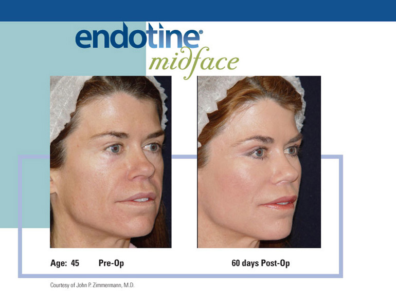 ENDOTINE Midface Before & After 5
