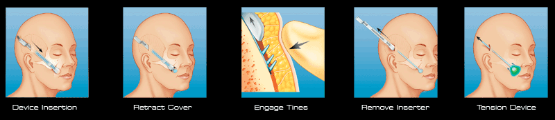 Endotine Midface Procedure Steps