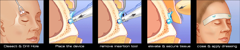 TransBleph Procedure Steps